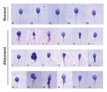 normal-and-abnormal-sperm-under-microscope